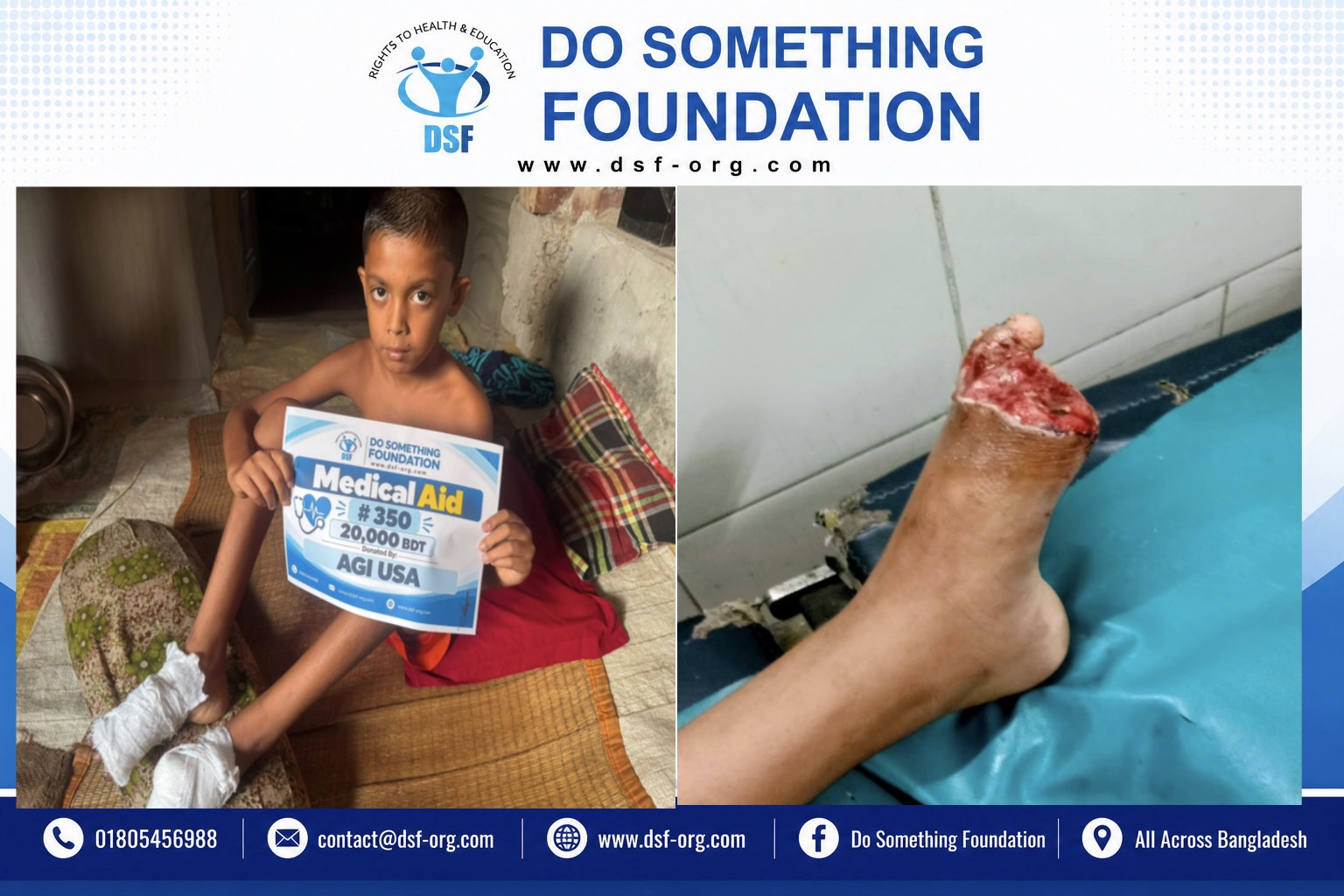 DSF Provides BDT 20,000 Medical Aid for Child Yasin